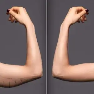 Arm Contouring