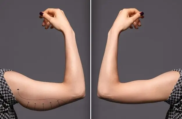 Arm Contouring